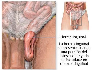 Si es posible balancearse a la hernia intervertebral