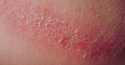 My Easy Home Remedies: Best Home Remedies For Chafing