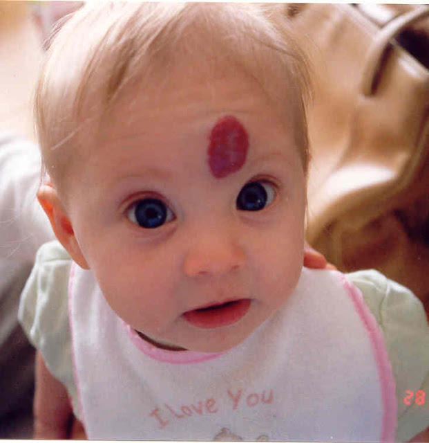 Redefining the Face Of Beauty CHILD SKIN DISORDER Hemangioma of Skin?