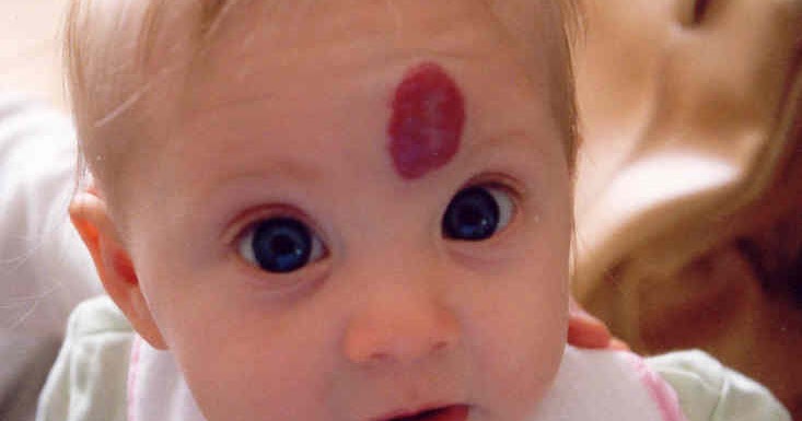 Redefining the Face Of Beauty : CHILD SKIN DISORDER: Hemangioma of Skin?