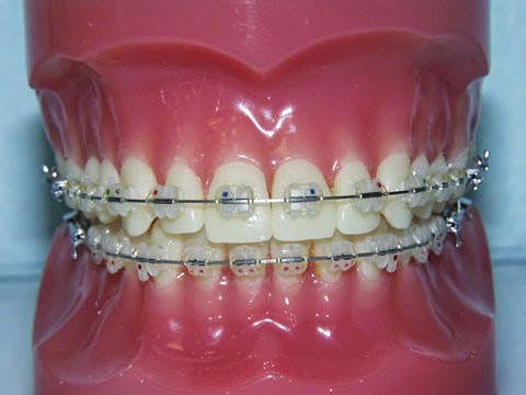 Assurance dentaire couverture complète pour appareils orthodontiques