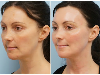 co2 skin fractional resurfacing before after surgery acne laser wrinkles brown downtime facial plastic spots fine scarring low