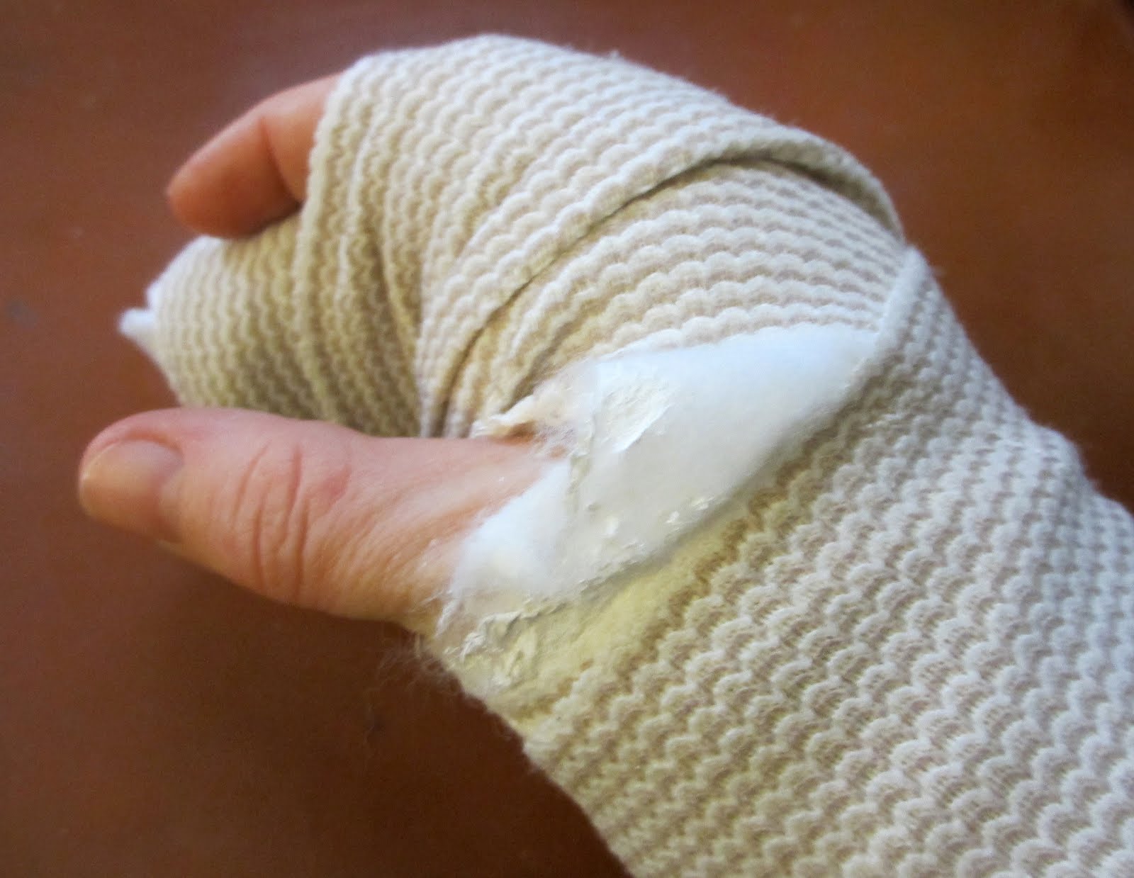 The Daily Apple Apple 617 Showering with a Cast