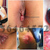 Obat wasir Selain faktu suppositoria di Apotek thumbnail