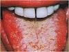 Gejala Awal Penyakit HIV dalam Mulut