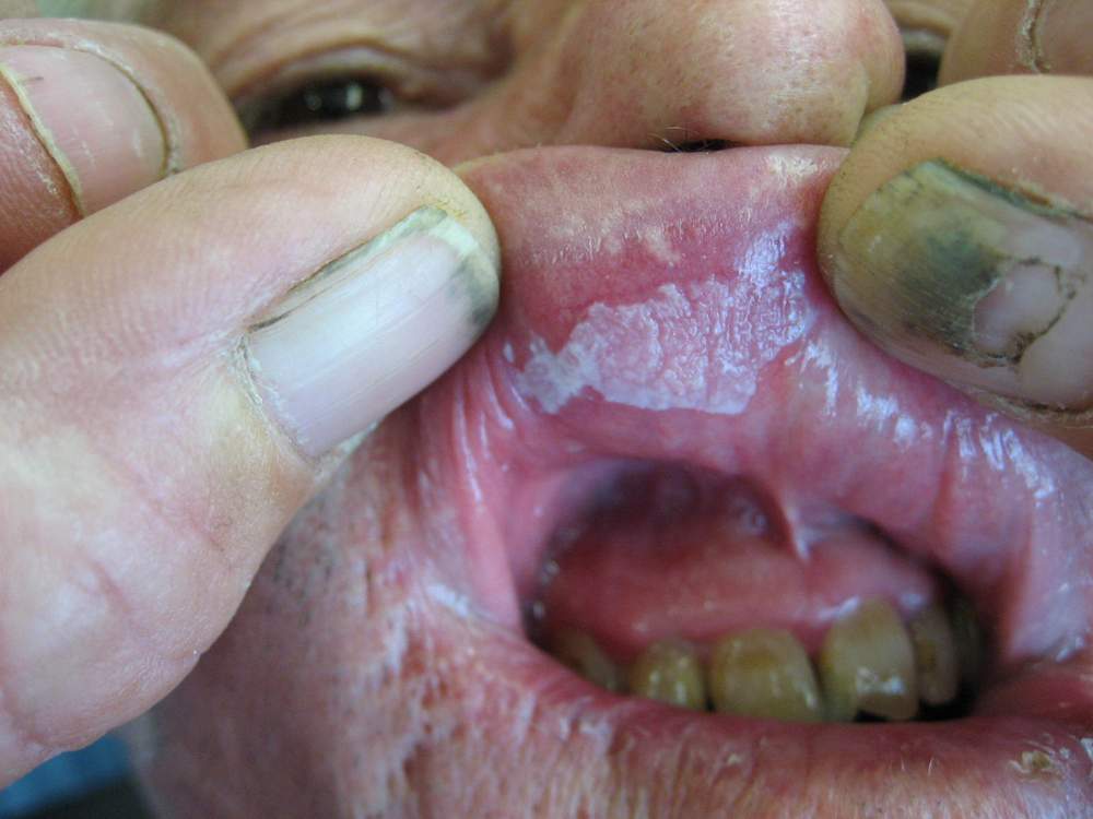 Dermatology For Dentists and Dental Students Lips
