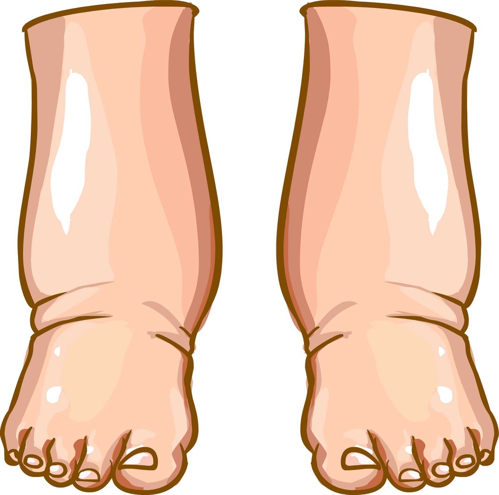 treatment for kidney disease Edema Means You Have Chronic Kidney