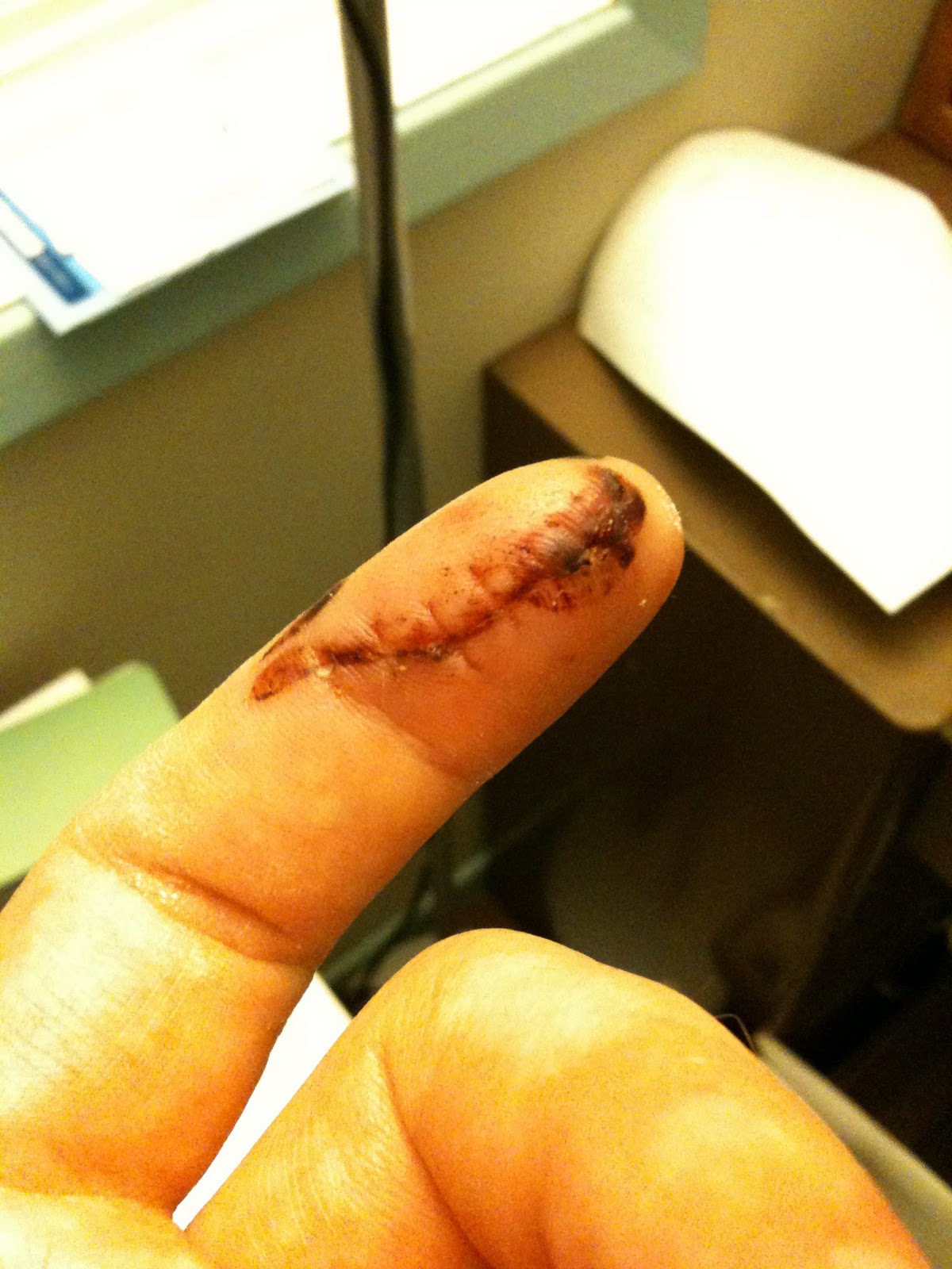 mutilated finger