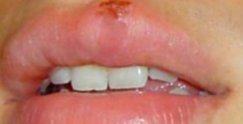 Primo infection herpes oral