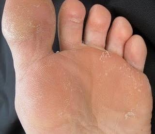 El masaje para los pies del hongo