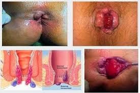 Ambein Ambein