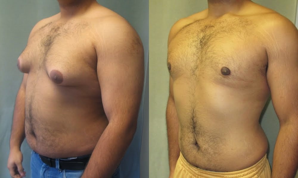 bras for severe gynecomastia