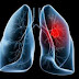 Increase In Lung Cancer Among Women At A Rate Of 2% Each Year