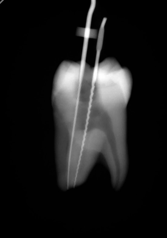 All Things Dentistry Episode 307/500 Endodontic Shift Shot