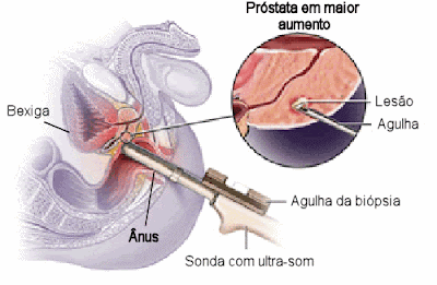 Biópsia da próstata