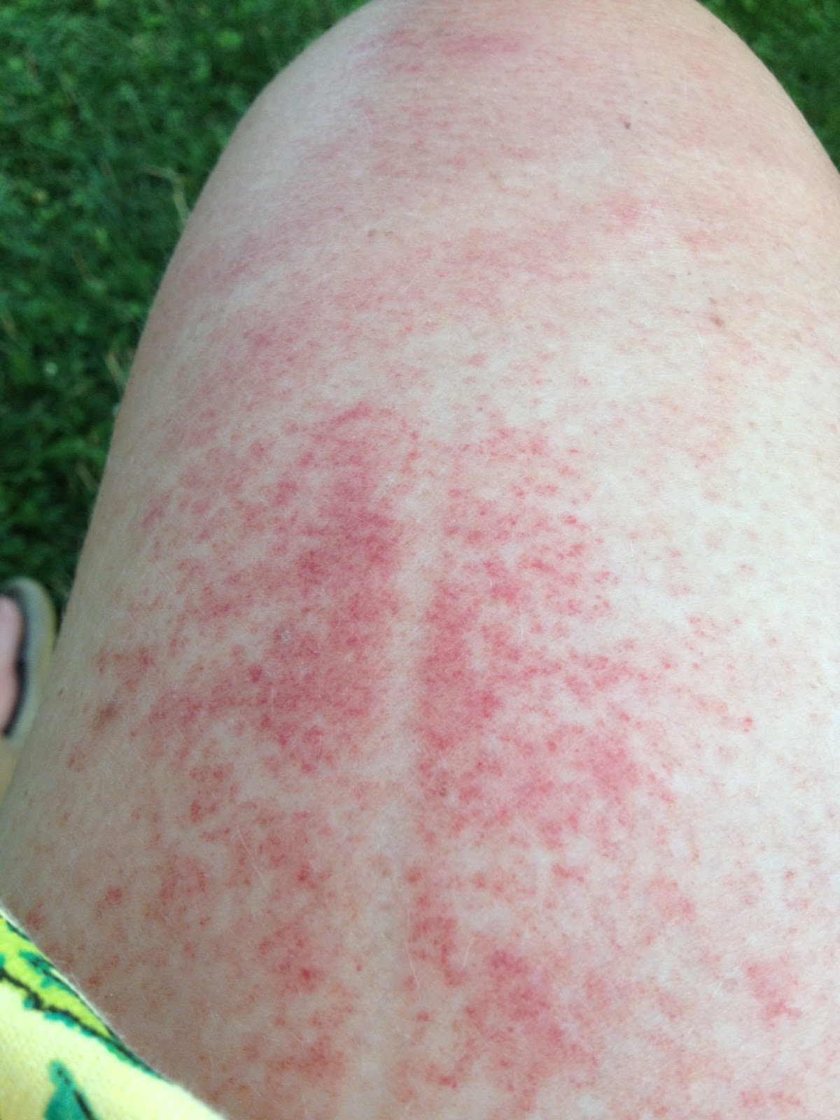 SUE'S ESCAPE FROM CANCERLAND Bicyclist's vasculitis