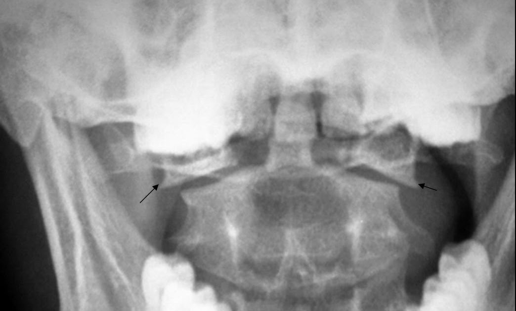 jefferson fracture jefferson fracture