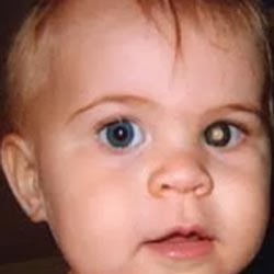 Medical Treatment Pictures For Better Understanding Cat Eye Cat Eye Syndrome Chromosome 22