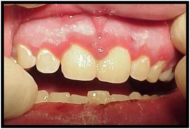 TRATAMIENTOS DENTALES: marzo 2011