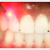 Parodontoza o boala a tesuturilor din jurul dintilor