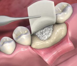 Parodontal procédure de greffe osseuse