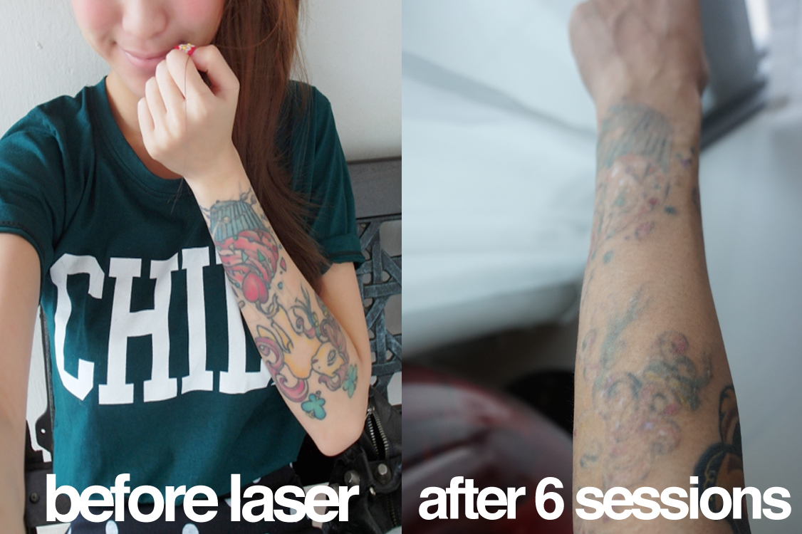 ohsofickle tattoo removal 4 ohsofickle tattoo removal 4