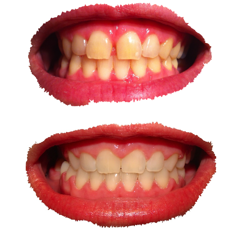 Mein Leben mit Zahnspange Vorher Nachher