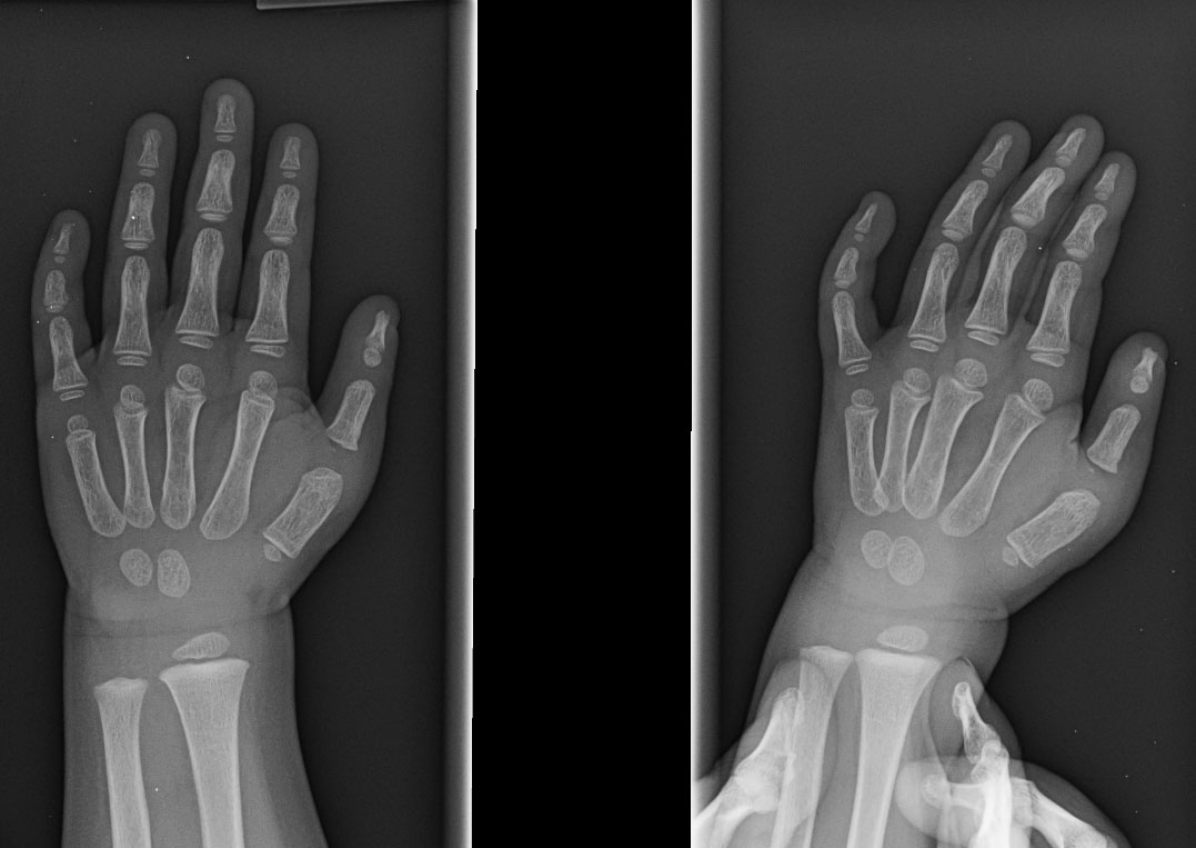 Extra Thumb Congenital Hand and Arm Differences