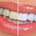 Tips Memutihkan Gigi Secara Alami 