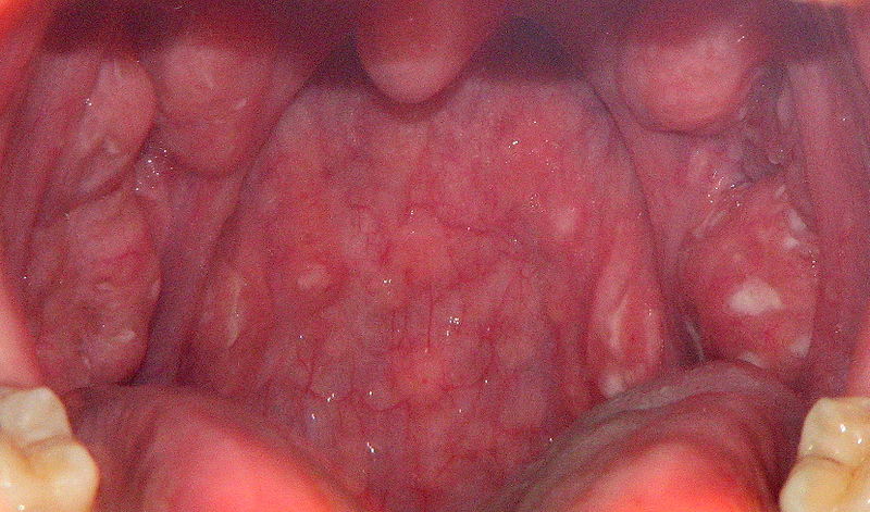 Throat Diseases