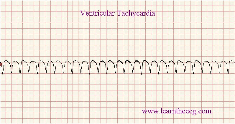 Ventricular Tachycardia Management Pdf