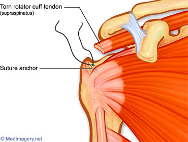 Steroid injection shoulder arthritis
