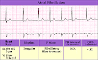 ATRIAL FIBRILLATION ATRIAL FIBRILLATION