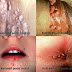 Obat Penyakit Kutil Kelamin Alami thumbnail