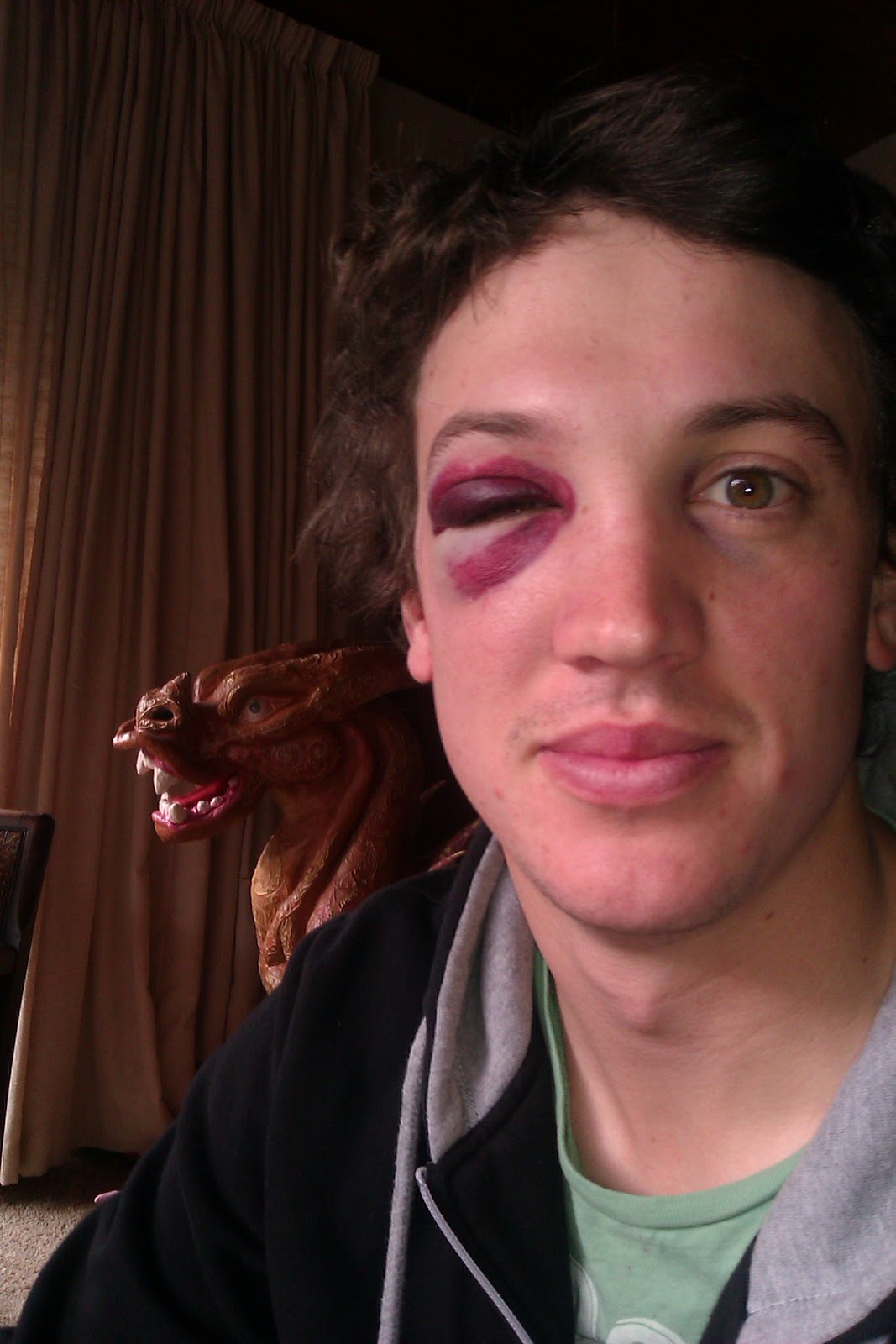 Rugby Black Eye
