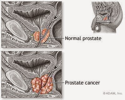 Kanker prostat adalah