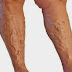 When is surgery necessary for varicose veins