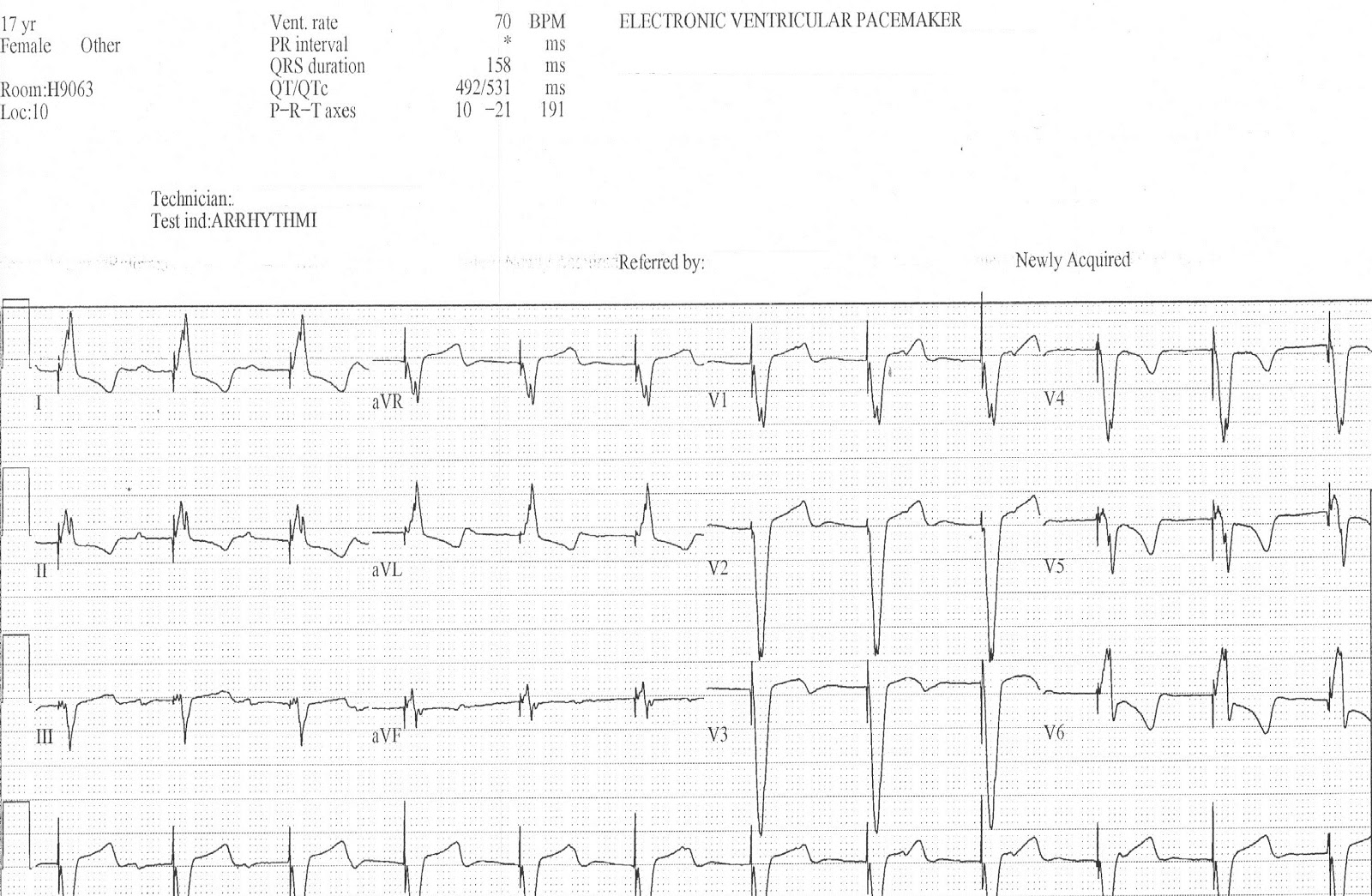 ekg with pacemaker