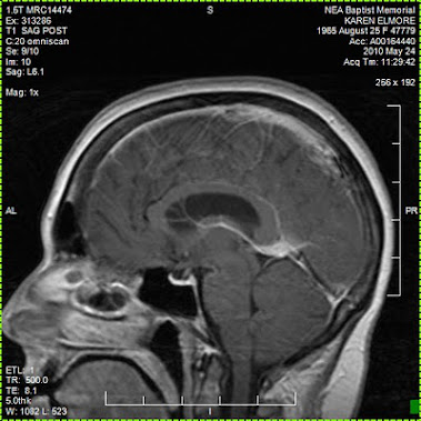 Brain MRI that shows the Venous Anomally that they called a Venous Angioma, at first,but a misnomer