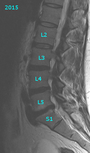 Can retrolisthesis be reversed image