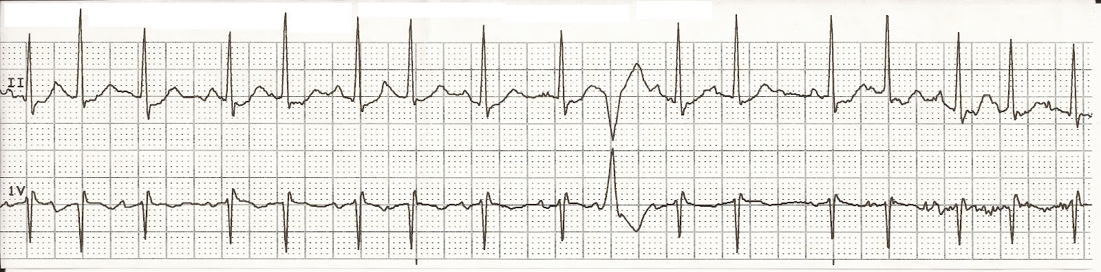 Float Nurse: EKG Rhyth...