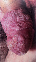 Cura di dermatite di atopic del quadro