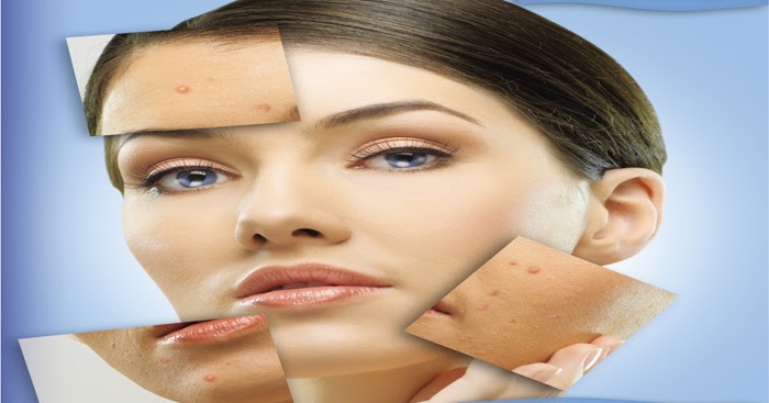 Accutane Isotretinoin Dermatologists Opinion