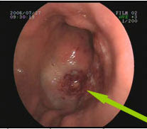 CÁNCER GÁSTRICO MÁS AVANZADO