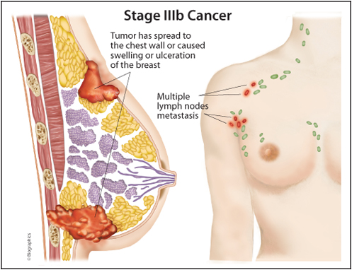 http://obatlimfomaherbal.blogspot.com/2014/01/wanita-kanker-payudara.html