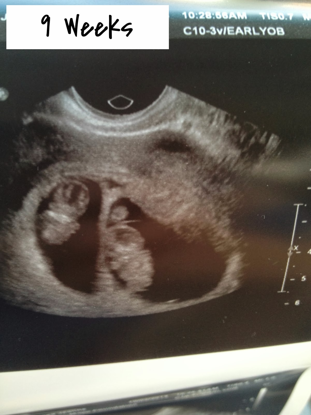 A baby for you 9 Weeks