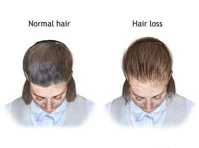 Hair Loss In Young Men