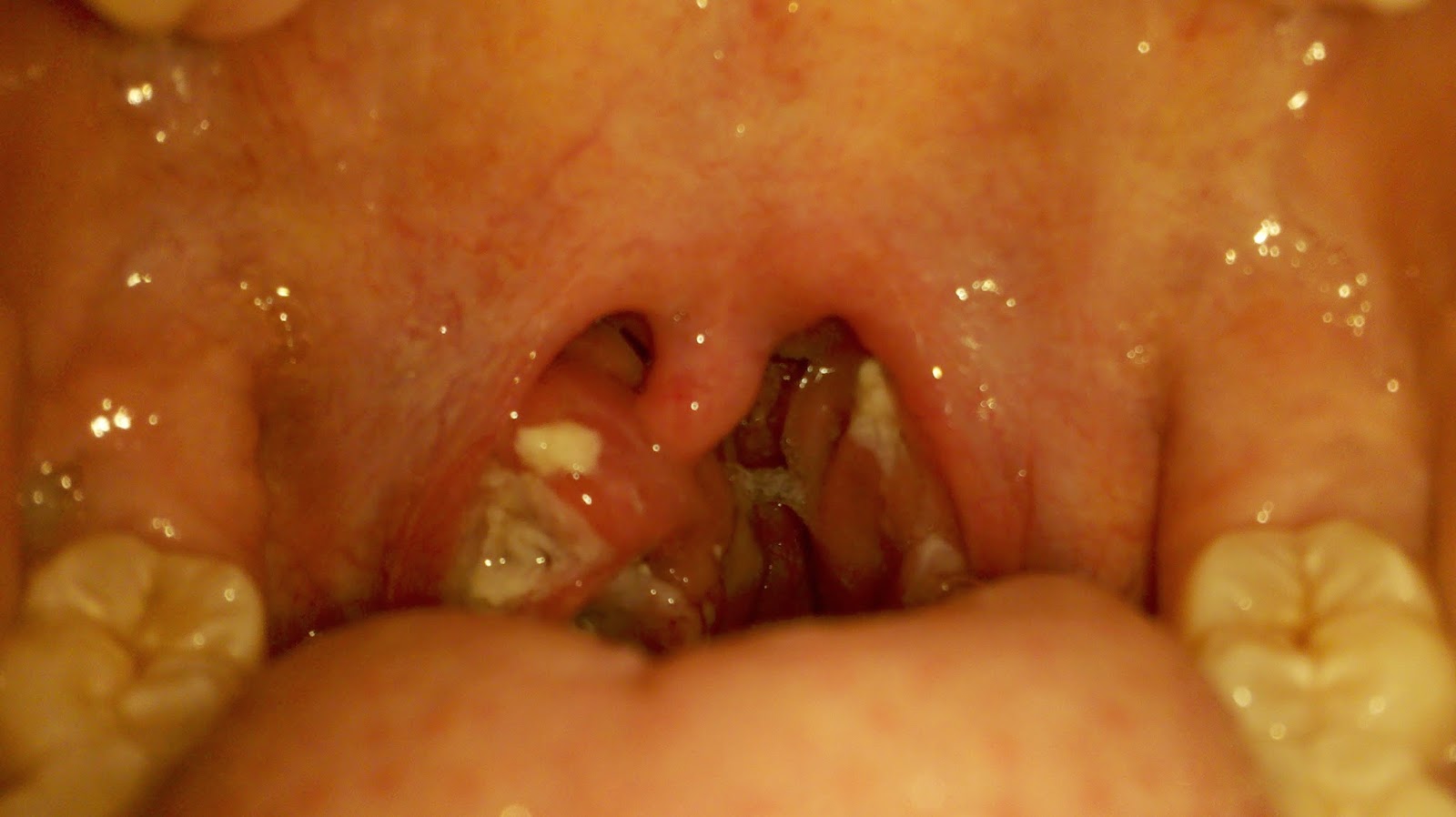 mono throat mono throat