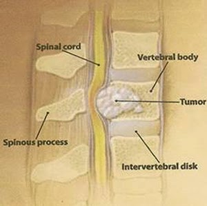 SPINAL TUMOR