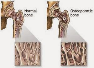 Normal and Osteoporotic Bone